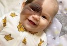 Parents’ Love Drives Them to Remove Daughter’s Birthmark